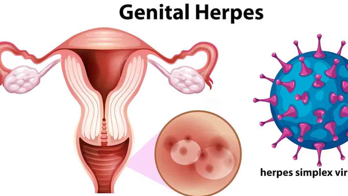 HPV vs HSV: Understanding The Differences Between Two Common STIs