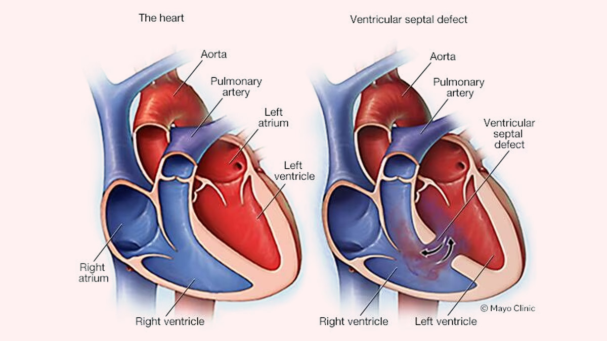Karan Singh Grover Discusses Daughter’s Heart Condition, Expert Shares What To Do If A Baby Has Holes In Heart