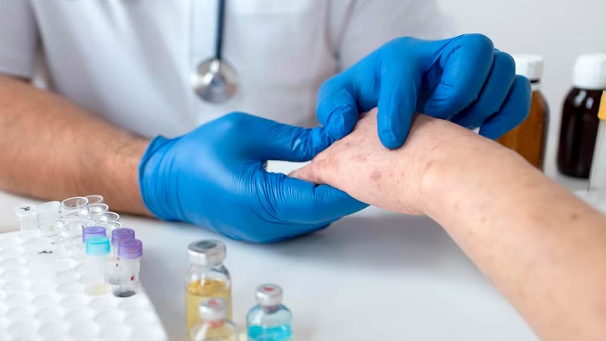 What Is Alaska Pox That Killed A Man In US' Alaska? | OnlyMyHealth