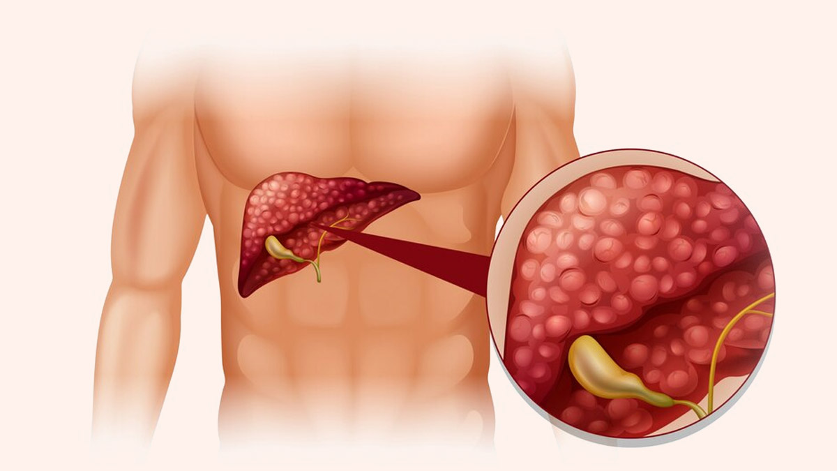 Can Carcinogens Affect Bile Duct?  Expert Explains All About Bile Duct Cancer 