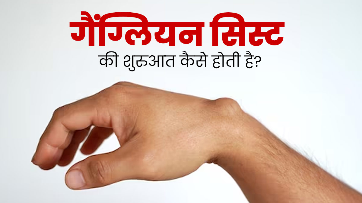  गैंग्लियन सिस्ट (हाथों या पैरों पर गांठें) की शुरुआत कैसे होती है? डॉक्टर से जानें