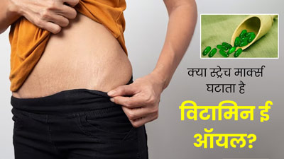 क्‍या स्ट्रेच मार्क्स को कम करने में असरदार है व‍िटाम‍िन E ऑयल? एक्‍सपर्ट से जानें