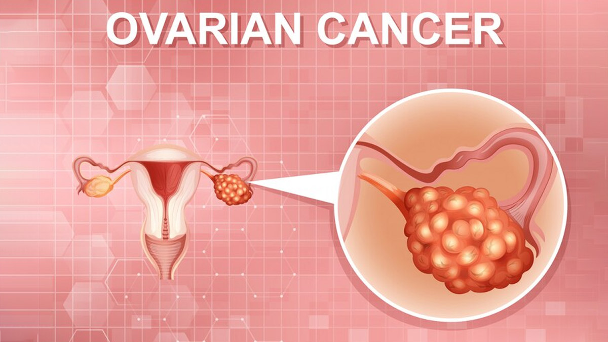 Does IVF Increase The Risk Of Ovarian Cancer Expert Explains In Hindi