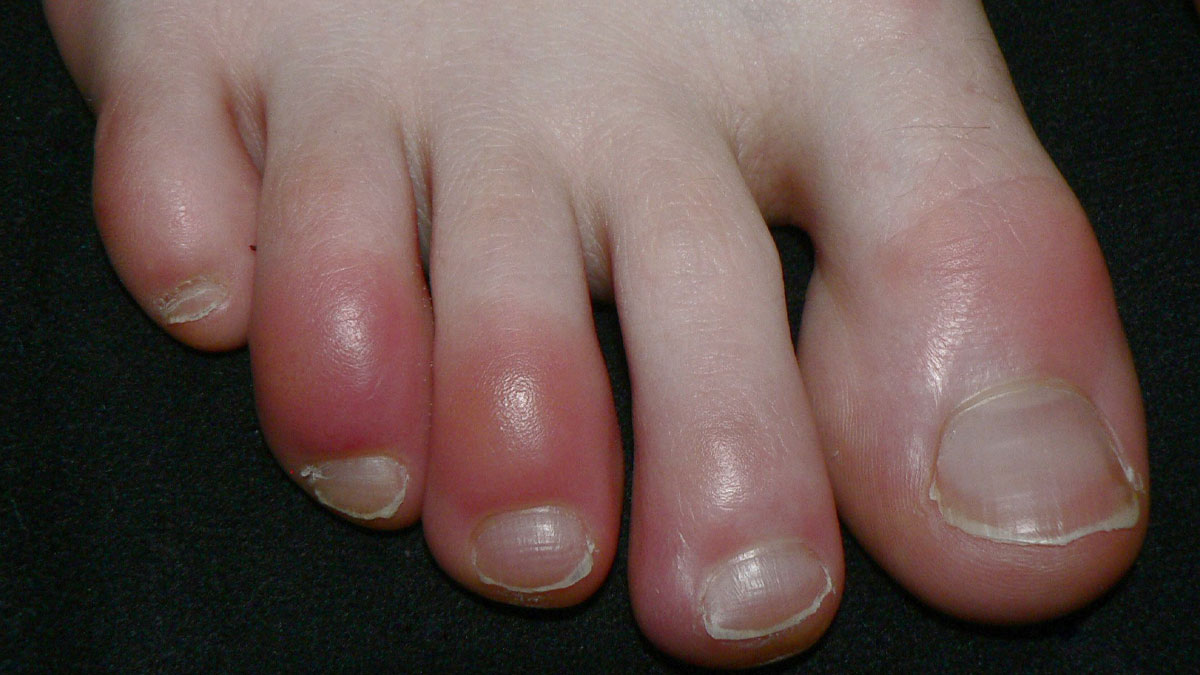 Chilblains: सर्दियों में बढ़ जाती है चिलब्लेन (सूजन और खुजली) की समस्या, राहत के लिए अपनाएं ये 4 घरेलू उपाय