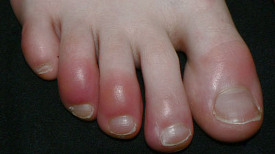 Chilblains: सर्दियों में बढ़ जाती है चिलब्लेन (सूजन और खुजली) की समस्या, राहत के लिए अपनाएं ये 4 घरेलू उपाय