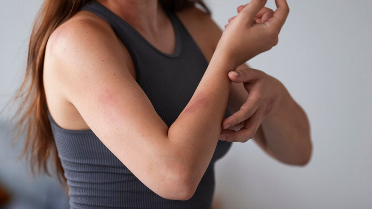 itching