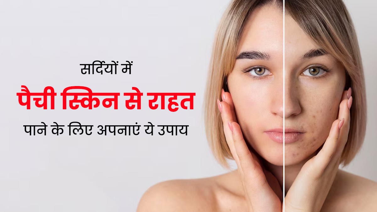 सर्दियों में Patchy Skin से राहत पाने के लिए अपनाएं ये 5 घरेलू उपाय, मिलेगी जल्दी राहत  