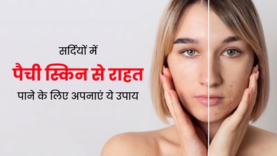 सर्दियों में Patchy Skin से राहत पाने के लिए अपनाएं ये 5 घरेलू उपाय, मिलेगी जल्दी राहत  