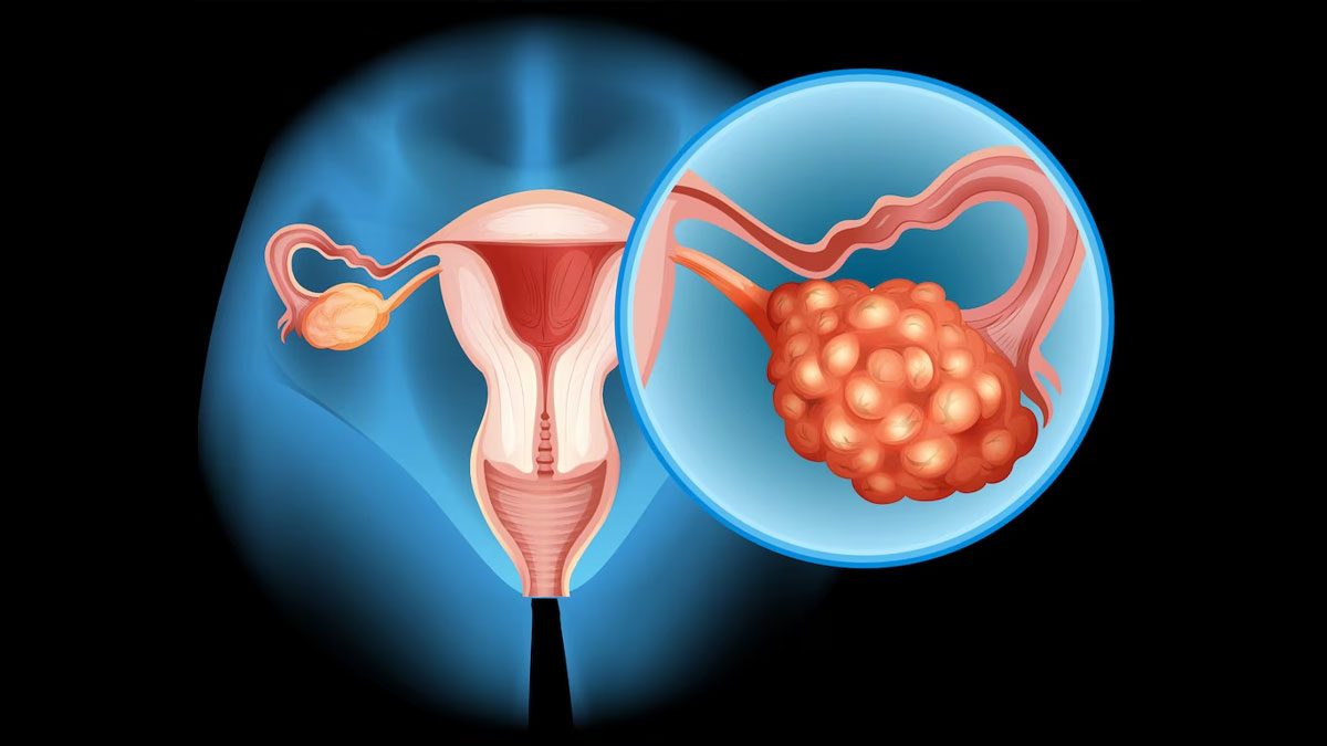 Causes Of Blocked Fallopian Tubes In Hindi