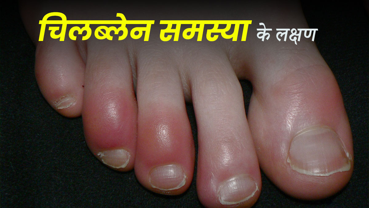 Chilblains Symptoms: चिलब्लेन की समस्या होने पर नजर आते हैं ये 5 लक्षण, न करें अनदेखा