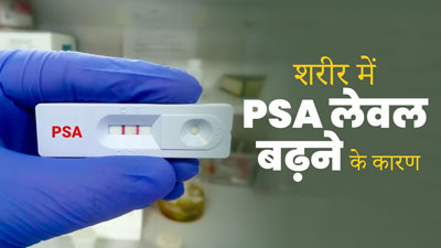 कैंसर के अलावा इन कारणों से भी बढ़ सकता है PSA लेवल, जानें कारण
