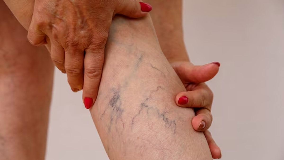 How To Treat Varicose Veins In Hindi