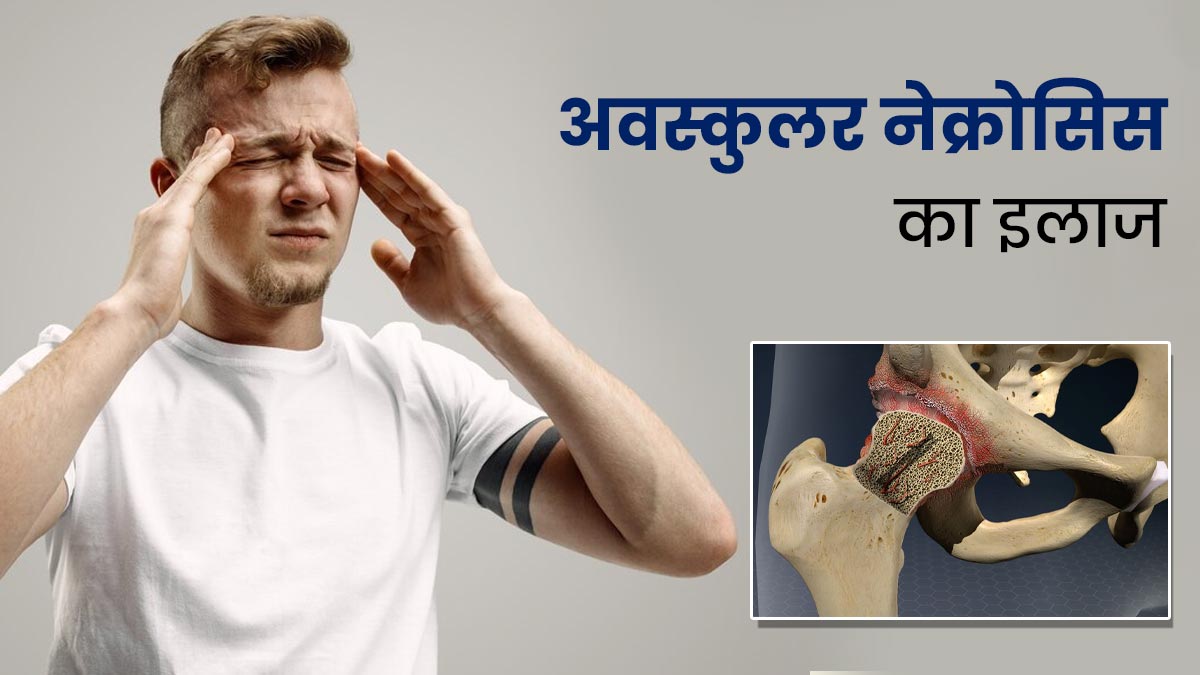 अवस्कुलर नेक्रोसिस (AVN) का इलाज क्या है? जानें डॉक्टर से