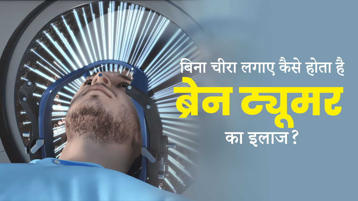 Brain Tumor Treatment: बिना चीरा लगाए इस तरह होता है ब्रेन ट्यूमर का इलाज, जानें इस तकनीक को व‍िस्‍तार से 