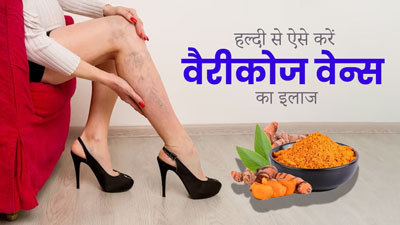 हल्दी से वैरीकोज वेन्स का इलाज कैसे करें? डॉक्टर से जानें इसके फायदे और प्रयोग का तरीका