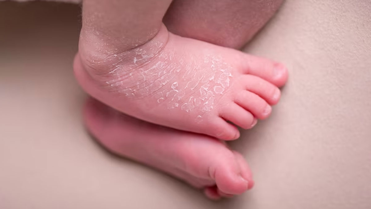 dry skin in babies