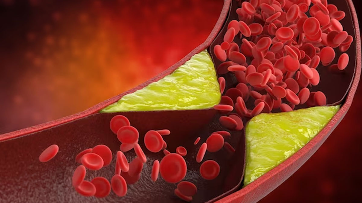 cholesterol problems