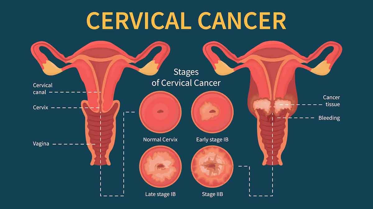 Expert Lists Preventive Measures Against HPV Causing Cervical Cancer