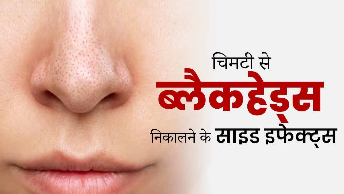 क्या चिमटी से चेहरे के ब्लैकहेड्स निकालना त्वचा के लिए सुरक्षित होता है? जानें एक्सपर्ट से  