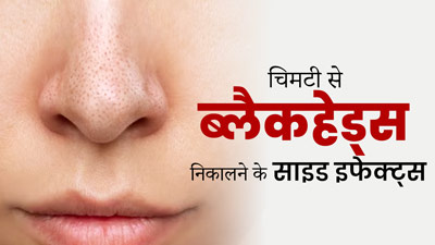 क्या चिमटी से चेहरे के ब्लैकहेड्स निकालना त्वचा के लिए सुरक्षित होता है? जानें एक्सपर्ट से  