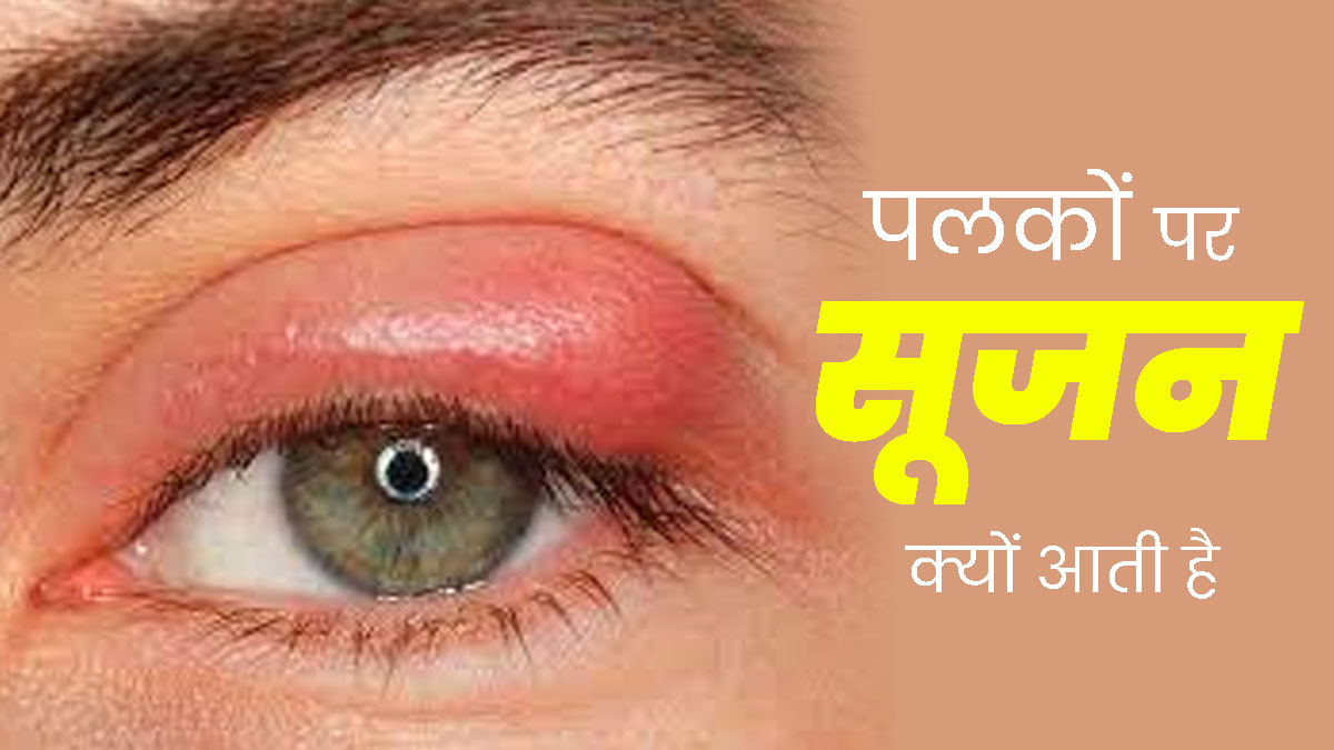 पलकों में सूजन आने के पीछे जिम्मेदार हो सकते हैं ये 5 कारण, डॉक्टर से जानें इसका इलाज