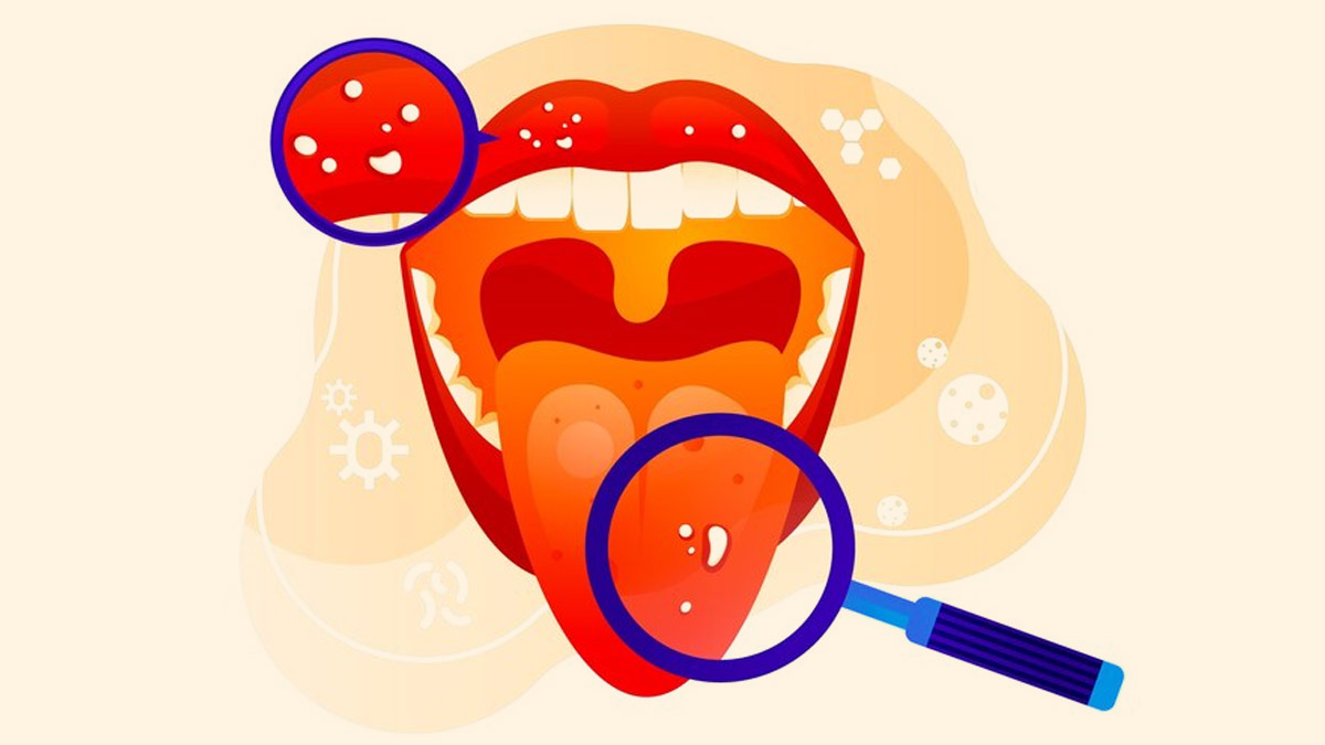 Symptoms Of Mouth Cancer | Onlymyhealth