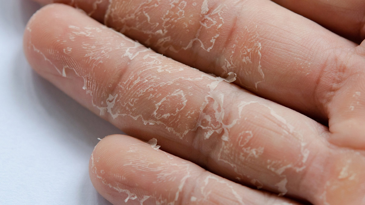 Underlying Medical Conditions That Cause Dry Peeling Skin OnlyMyHealth