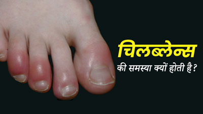 Chilblains: चिलब्लेन्स की समस्या क्यों होती है? जानें इसके 5 कारण 