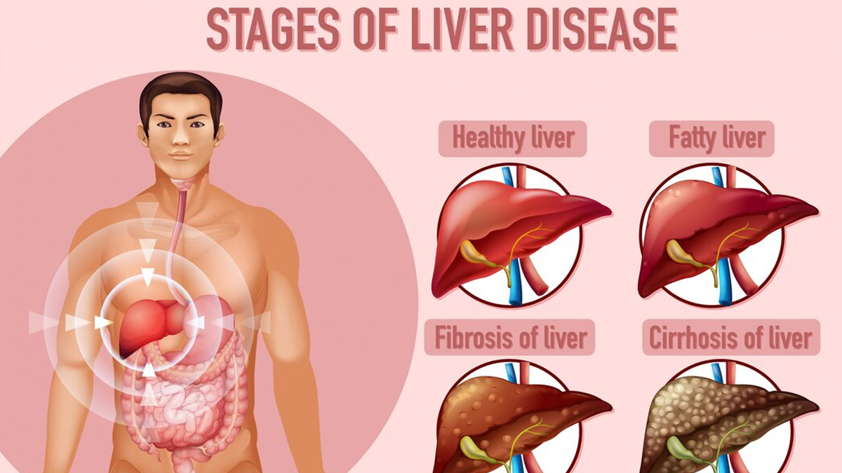 Are Egg Yolks Safe For People With Fatty Liver Disease? Here’s The ...