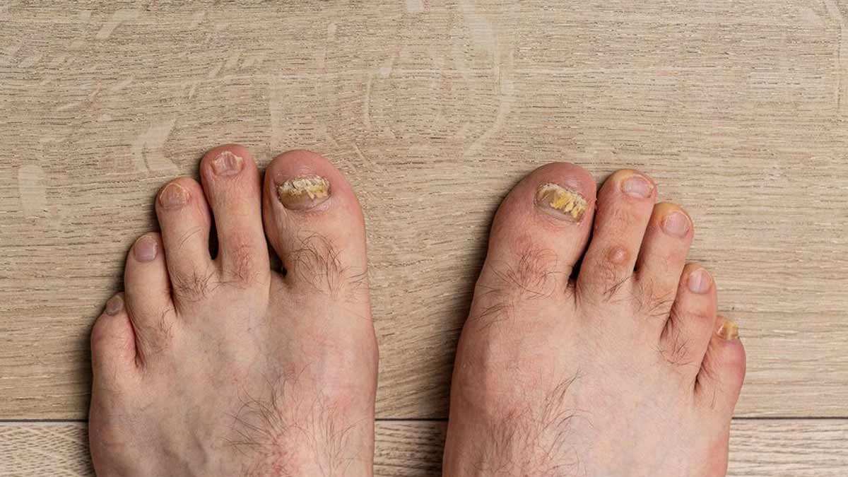 Infected toes in type 1 diabetes - Stock Image - C037/0841 - Science Photo  Library
