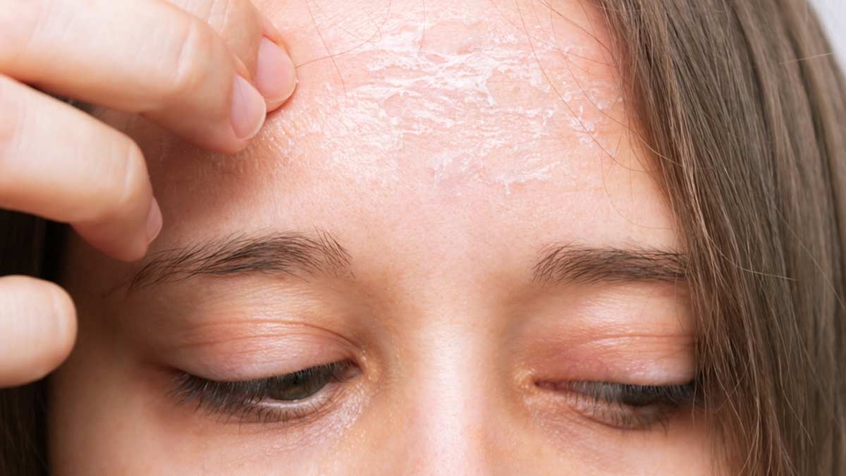 Skin Pilling: Expert Explains What It Is, Its Causes, And Preventive Tips |  OnlyMyHealth