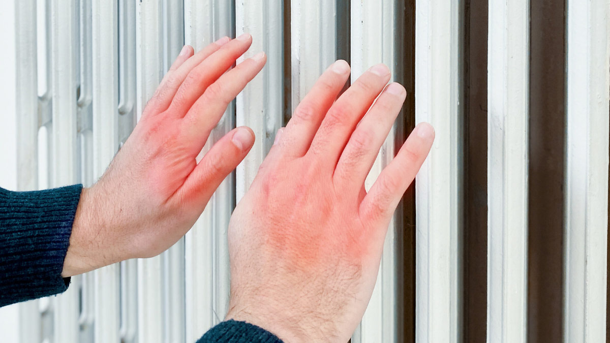 चिलब्लेन्स की समस्या किस विटामिन की कमी से होती है? एक्सपर्ट से जानें