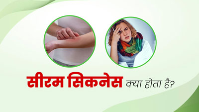 Serum Sickness: सीरम सिकनेस होने पर नजर आते हैं रैशेज और बुखार जैसे लक्षण, जानें इसका कारण और इलाज