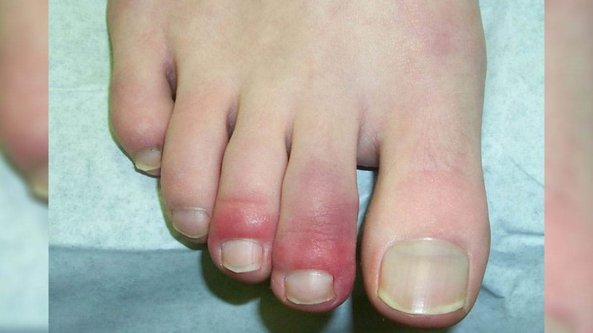 Chilblains and vitamin deficiency