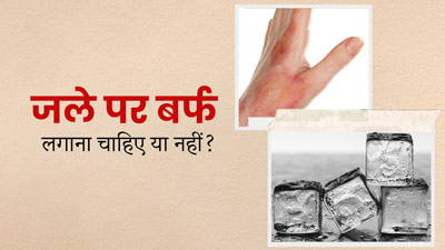 क्या जली हुई स्किन पर बर्फ लगाना सही होता है? जानें डॉक्टर से 