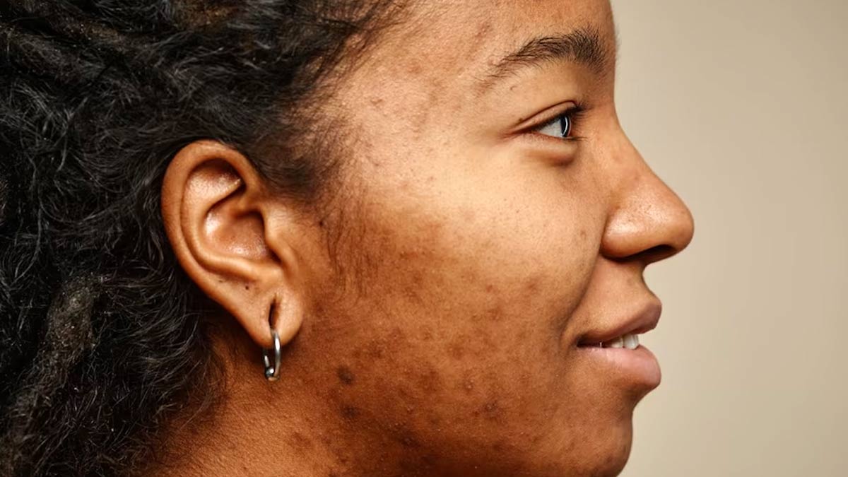 Tired Of Pigmented Skin? Here Are Some DIY Scrubs That Can Lighten Your Skin’s Dark Spots