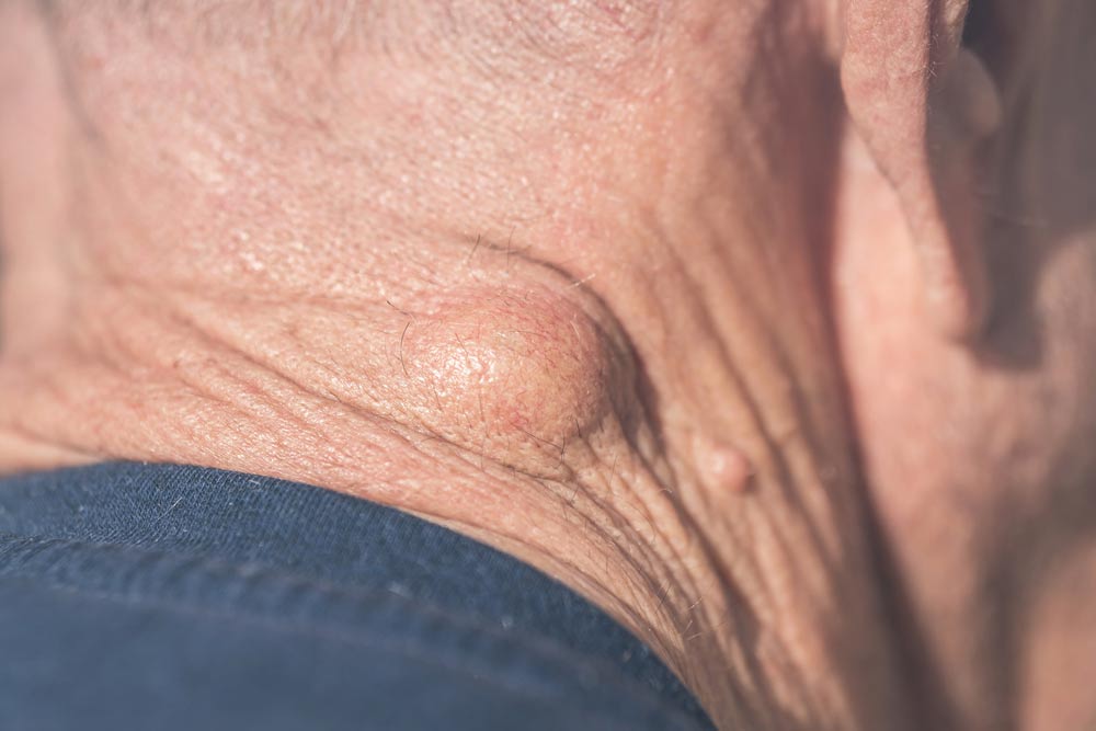 lipoma-or-cancer-how-to-know-what-the-fatty-lump-in-your-skin-means