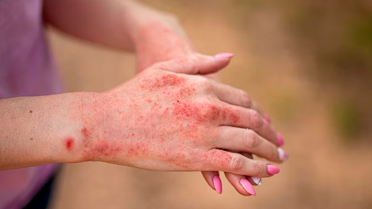 Understanding and Alleviating Eczema Symptoms