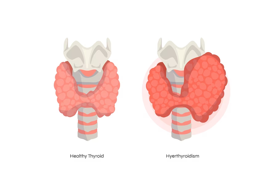 hypothyroidism-and-weight-management-7-tips-for-finding-the-balance