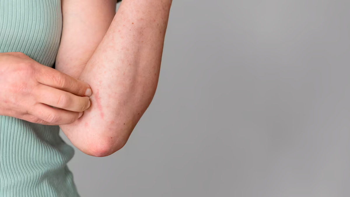 Understanding and Alleviating Eczema Symptoms