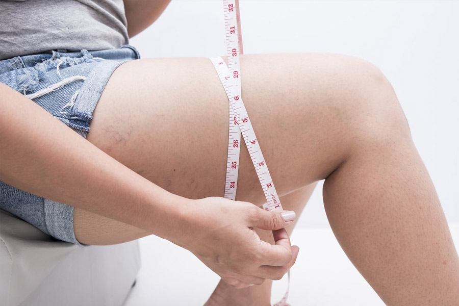 thigh fat causes 