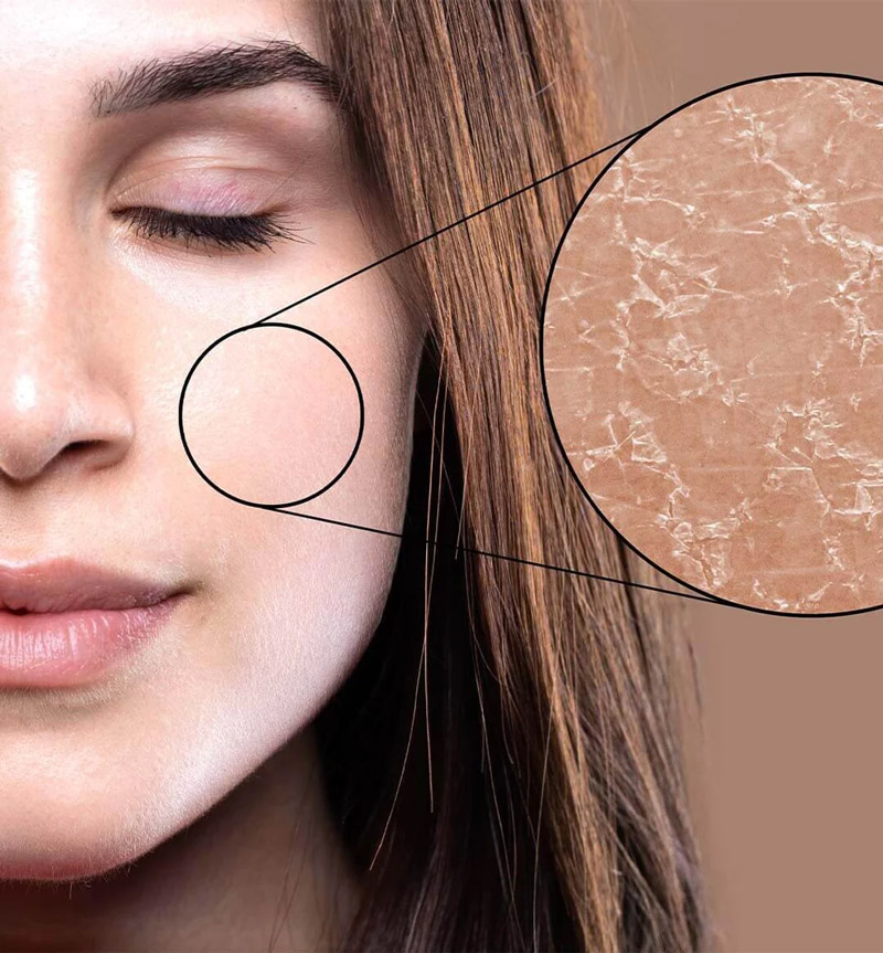 dry skin
