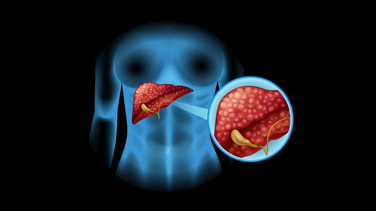 How Serious Is Cancer Of The Gallbladder In Hindi