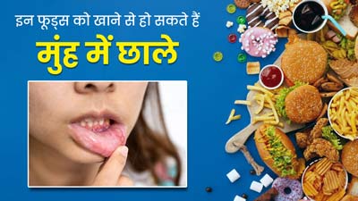 मुंह में छाले का कारण बनते हैं ये 5 फूड्स, जानें क्यों करना चाहिए इनसे परहेज