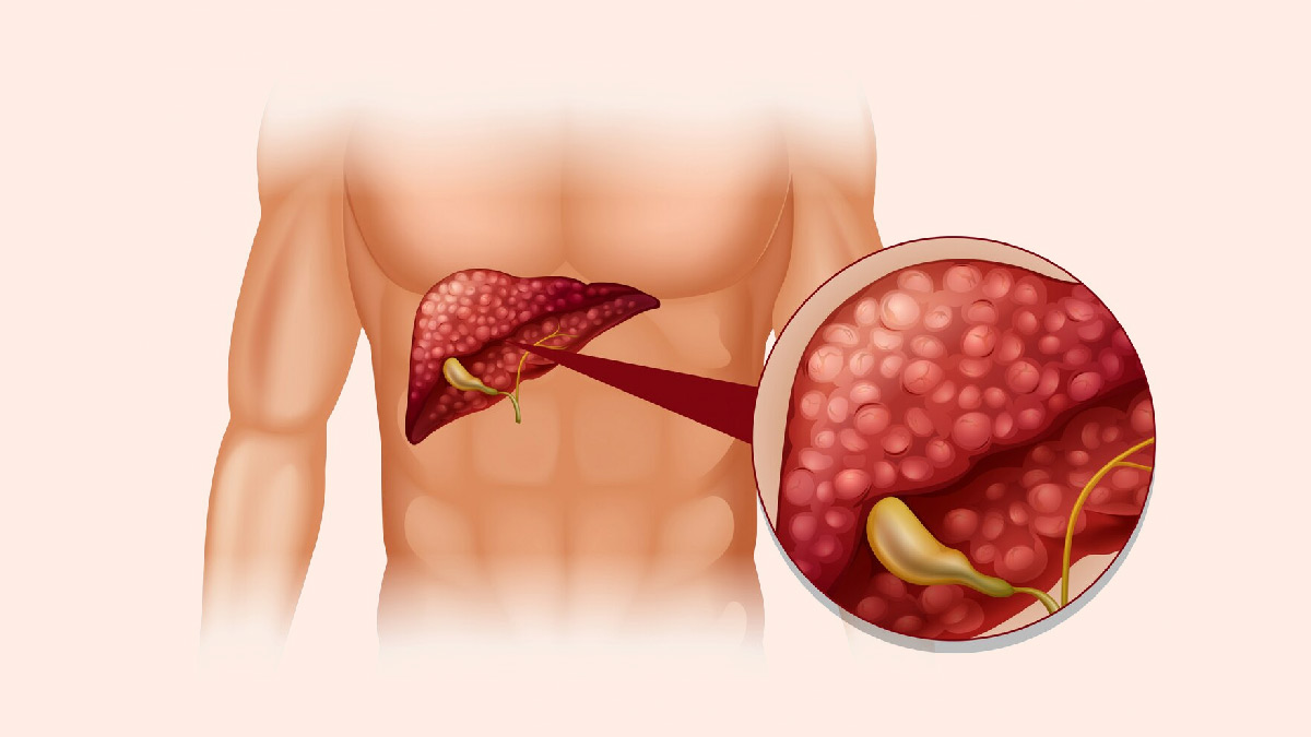 Untreated NAFLD Can Increase Your Risk Of Cancer: Here's How You Can Prevent It