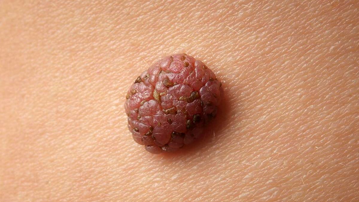 Benign Tumours: Should They Be Removed Or Left Alone?