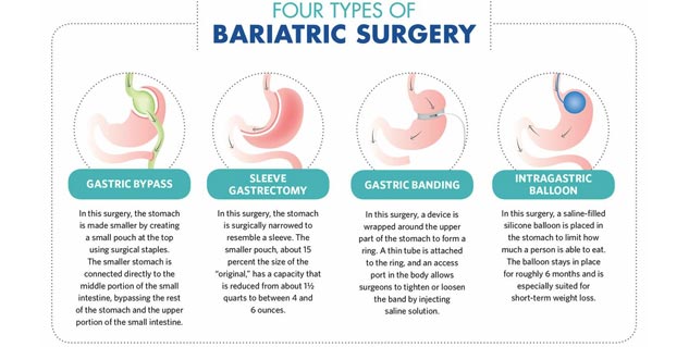 Expert Shares Precautions Before and After Bariatric Surgery