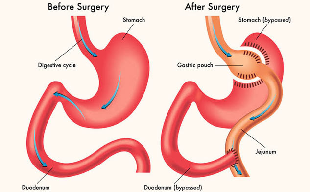 Expert Shares Precautions Before and After Bariatric Surgery