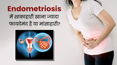 Endometriosis Diet: एंडोमेट्रियोसिस में शाकाहारी खाना ज्यादा फायदेमंद है या मांसाहारी, जानें डॉक्टर से