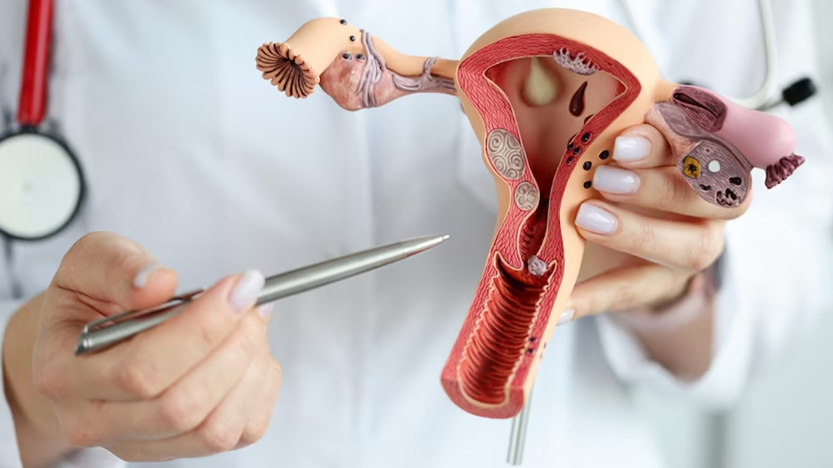 Cervical cancer